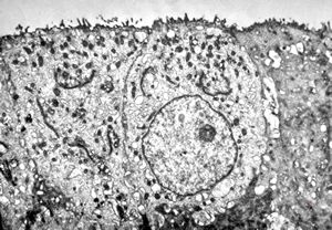 M,18y. | immotile cilia syndrome - bronchus